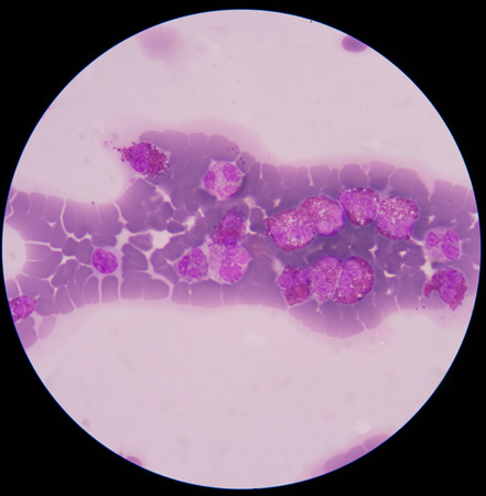 blood smear is often used as a follow-up test to abnormal results on a complete blood count (CBC) to...