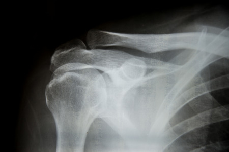 X-ray film of shoulderの写真素材