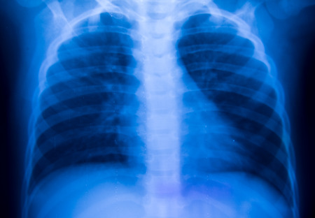 View of a  x-ray film, taken to  the lungs.の写真素材