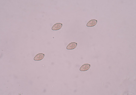 Egg parasite in stool exam real sample.
