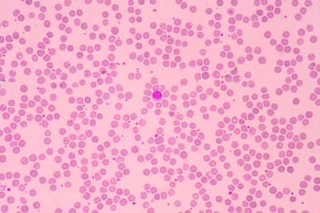 blood smear is often used as a follow-up test to abnormal results on a complete blood count (CBC) to evaluate the different types of blood cells.の写真素材