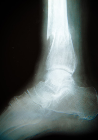 x-ray of ankleの写真素材