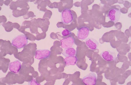 Leukemia cellsの写真素材