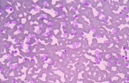 Leukemia cellsの写真素材