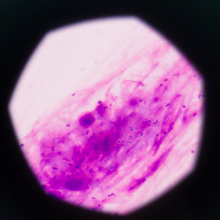 Gram staining, also called Gram's method, is a method of differentiating bacterial species into two...