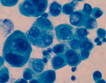 Cancer Cell in blood cells human showing abnormal cells.の写真素材