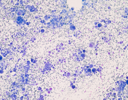 Cancer Cell in blood cells human showing abnormal cells.