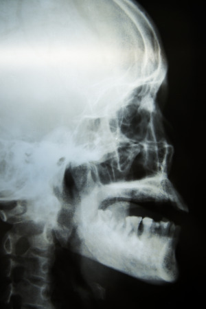 X-ray picture of the skullの写真素材