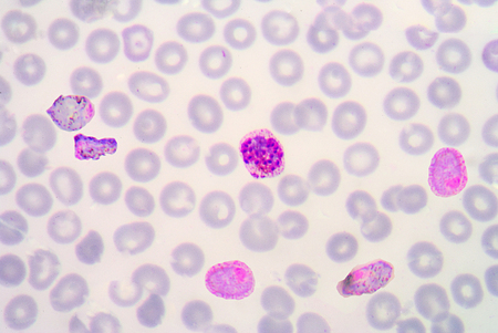 blood films for Malaria parasite.show malaria pigment.の写真素材