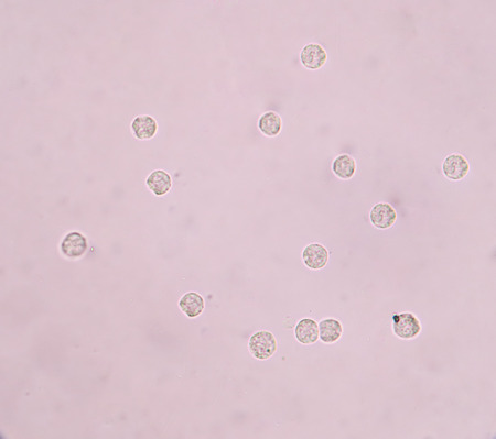 Moderate White blood cells in urine.Woman petain urinary tract infection.