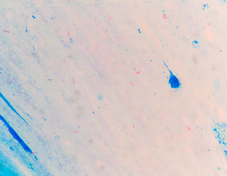 Positive red cells on blue background.Mycobacterium tuberculosis is a pathogenic bacterial species...