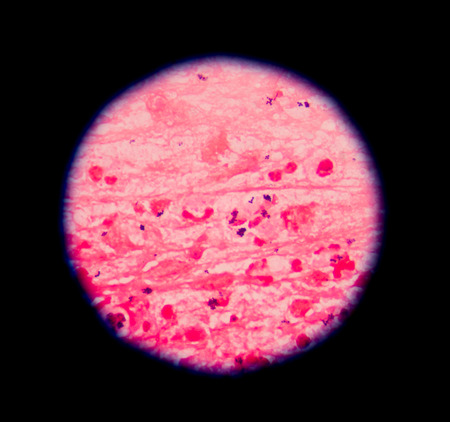 Gram stain showing blue cells gram positive in single,in pair,in cluster intracellular on red white...