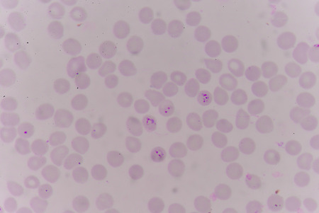 blood films for Malaria parasite.show malaria pigment.の写真素材