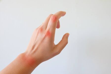 Rheumatoid Arthritisの写真素材