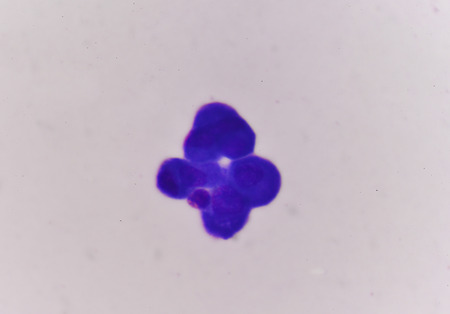 Abnomal cells look like malignant cells from specimen plural fluid.の写真素材