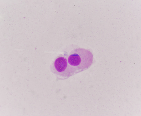Abnomal cells look like malignant cells from specimen plural fluid.の写真素材