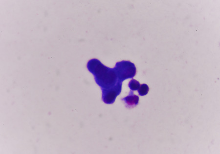 Abnomal cells look like malignant cells from specimen plural fluid.の写真素材