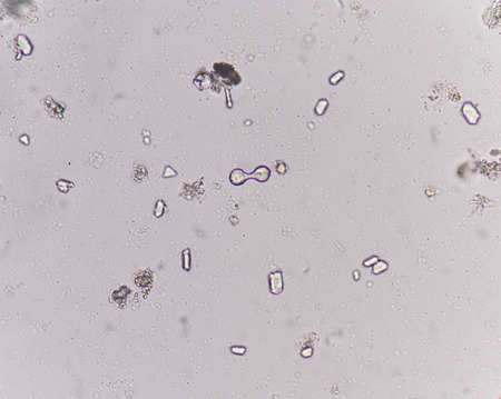 Moderate triple phosphate with bacteria in urine analysis medical science education concept.の写真素材