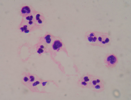 Sepsis or septicaemia is a life-threatening illness.の写真素材