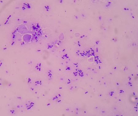 Sepsis or septicaemia is a life-threatening illness.の写真素材