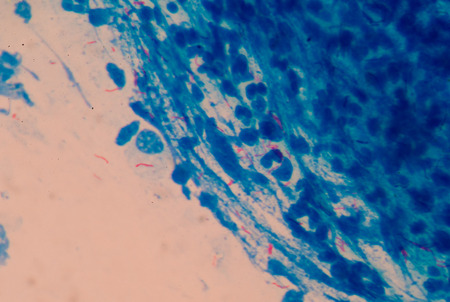Red cells microbacterium tuberculosis on blue background medical science.の写真素材