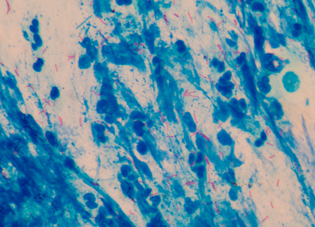 Red cells microbacterium tuberculosis on blue background medical science.
