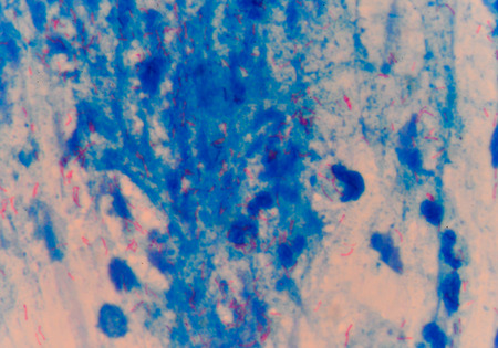 Moderate red cells mycobacterium tuberculosis on blue background.