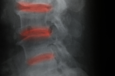 Close up spinal cord   x-ray medical science backgroundの写真素材