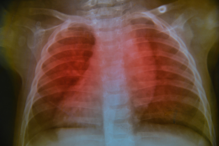 Close up chest child   x-ray medical science background