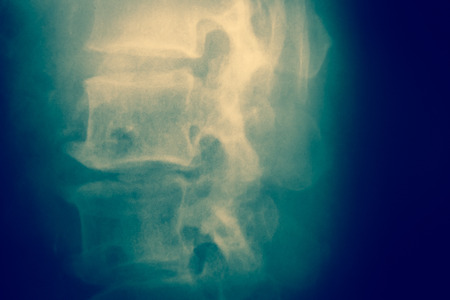 Close up spinal cord bone  x-ray medical science backgroundの写真素材