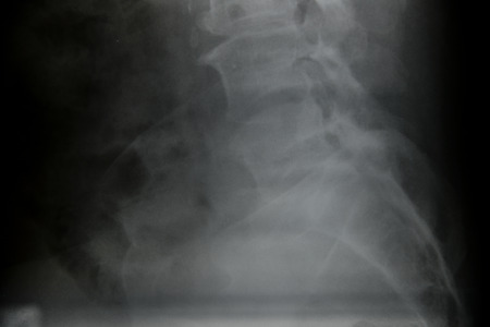 Close up spinal cord bone  x-ray medical science background