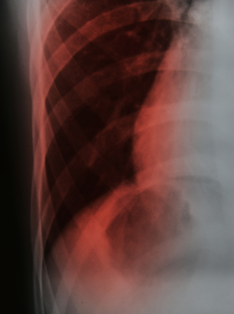 Close up chest x-ray tb patient medical science backgroundの写真素材