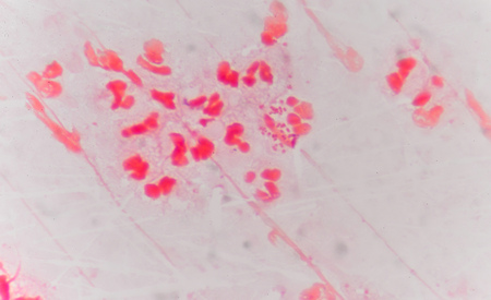 Moderate red white blood cells with gram negative diplococci intracellular Gram-negative coffee...