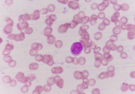 Blast cells in blood smear specimen Leukemia petient.の写真素材