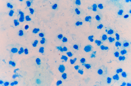 Moderate blue white blood cells sputum smear.