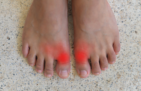 Foot of gout patient.Close up Painful and inflamed gout.の写真素材