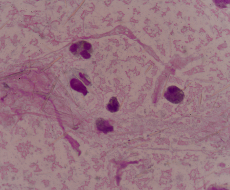 Moderate Uric acid crystal needle shape in synovial fluid find with microscope.wright stain method.