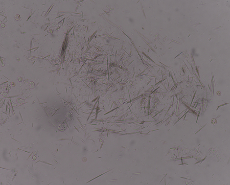 Moderate Uric acid crystal needle shape in synovial fluid find with microscope.