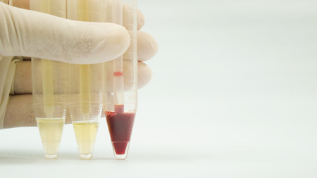 Close up Urine in tube  sediment analysis on white.の写真素材