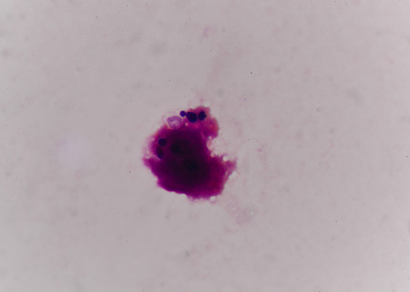 budding yeast cell with epithelial in gram stain method.