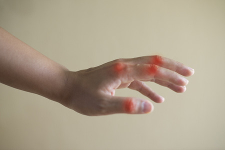 close up hand rheumatoid arthritis pateint.medical concept.の写真素材