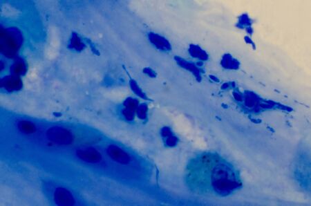 Poor sample for acid fast bacilli testing.Budding yeast cells squamous epithelial cells blue cells.