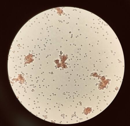 Red blood cells agglutination in crossmatching test incompatible reation.Shooting by camera phone.