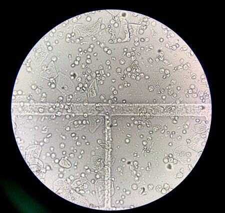 Sediment urine finding with  microscope.Moderate bacteria and white blood cells in patien bacteria...
