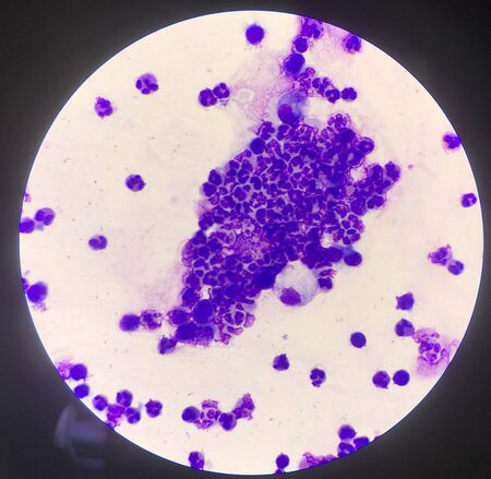 Group of inflammation cells ascitic fluid sample laboratory concept.