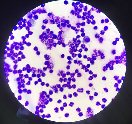 Group of inflammation cells ascitic fluid sample laboratory concept.