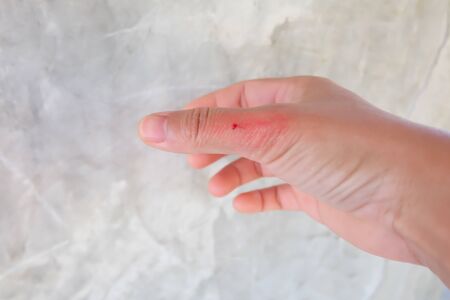 Close up red wound in finger on blur background.