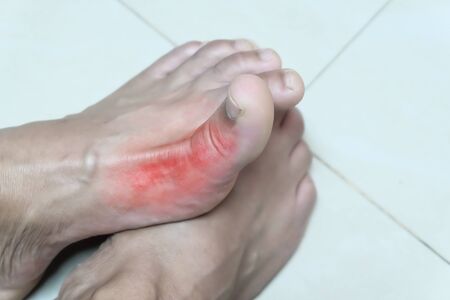 Close up foot  arthritis male on floor.
