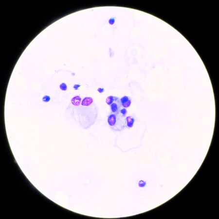 Group of Abnormal cell in plural fluid find with microscope.
