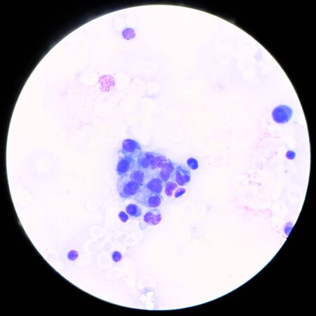 Group of Abnormal cell in pleural fluid find with microscope.